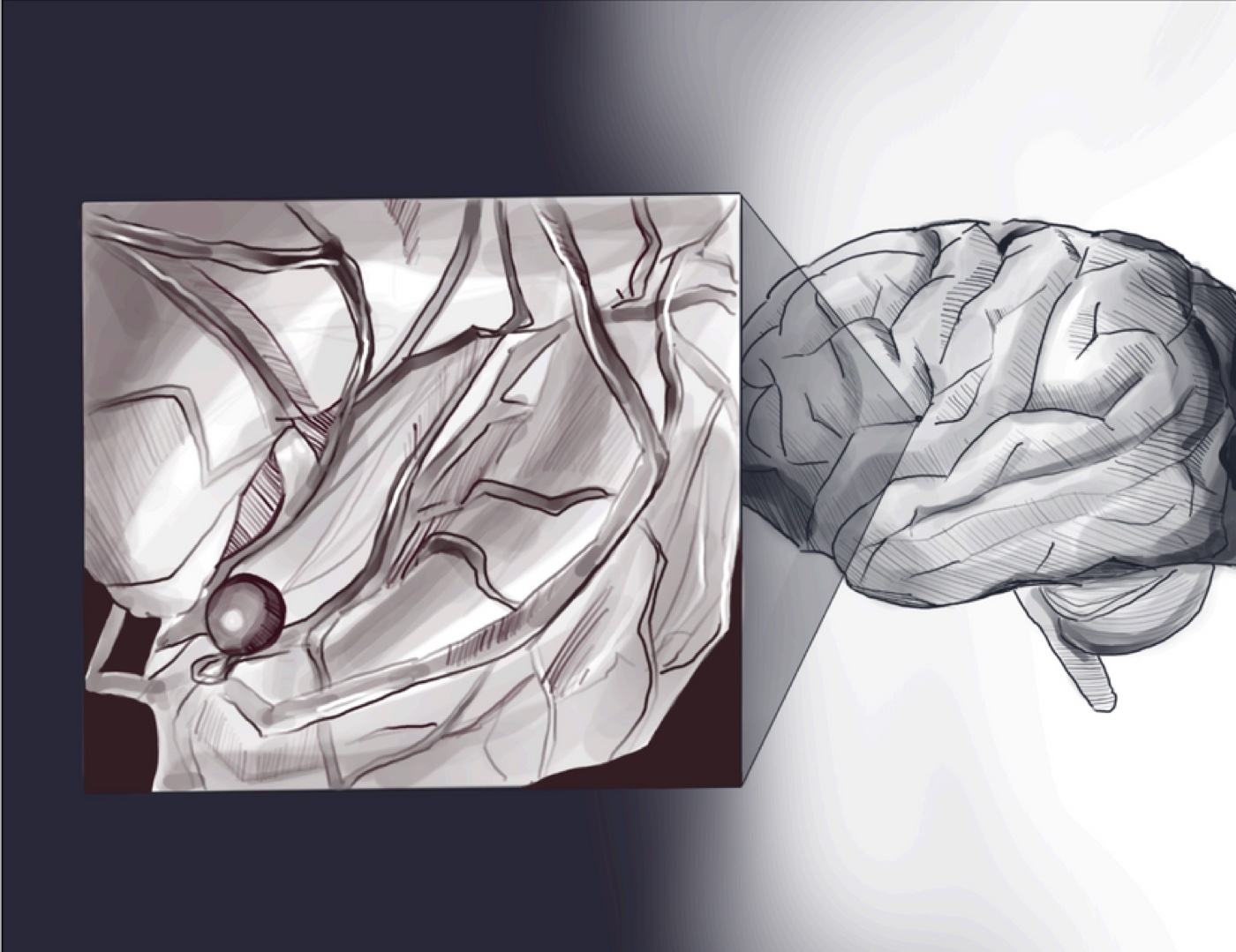 Pencil illustration of a human brain with an inset close-up showing an aneurysm bulging from a cerebral blood vessel.