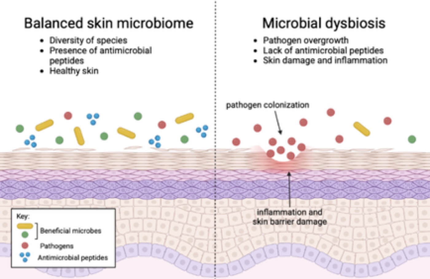 Diagram comparing a balanced skin microbiome with a dysbiotic one.